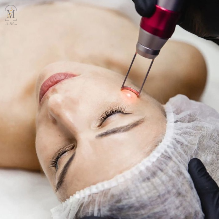 Q Switch Laser Treatment