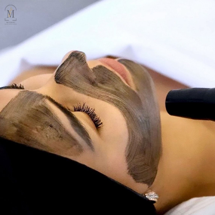 Carbon Facial Treatment