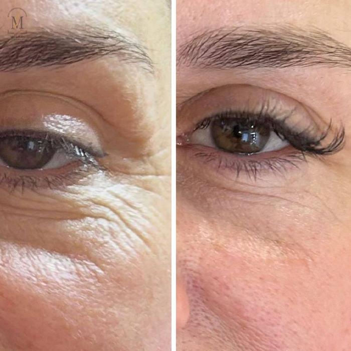 Photofacial Treatment