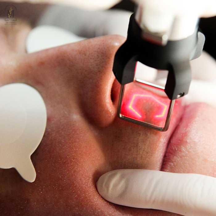 CO2 Fractional Laser for Acne Scars