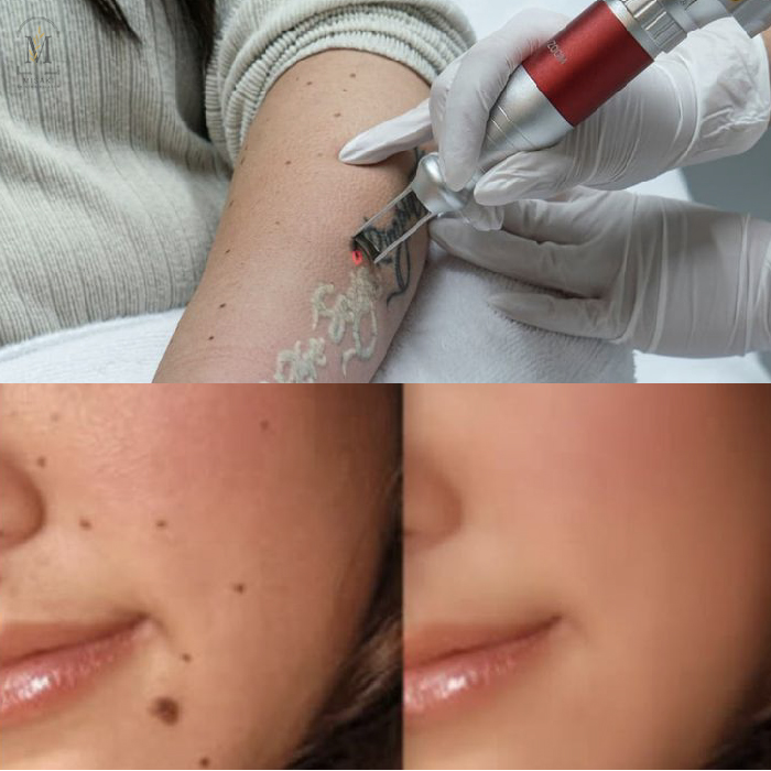 Pigmentation Treatment